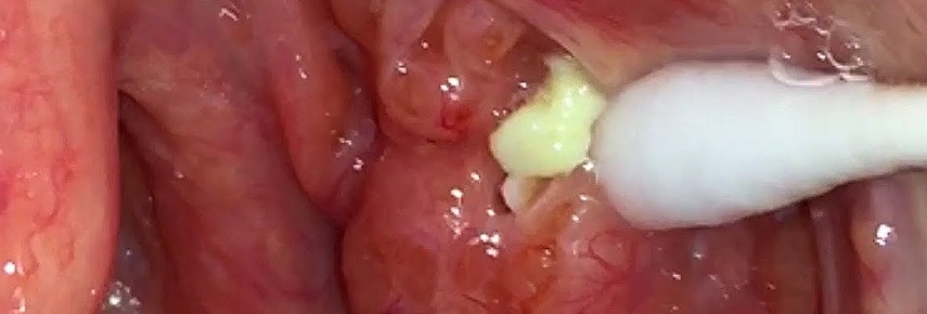 Tonsil stone